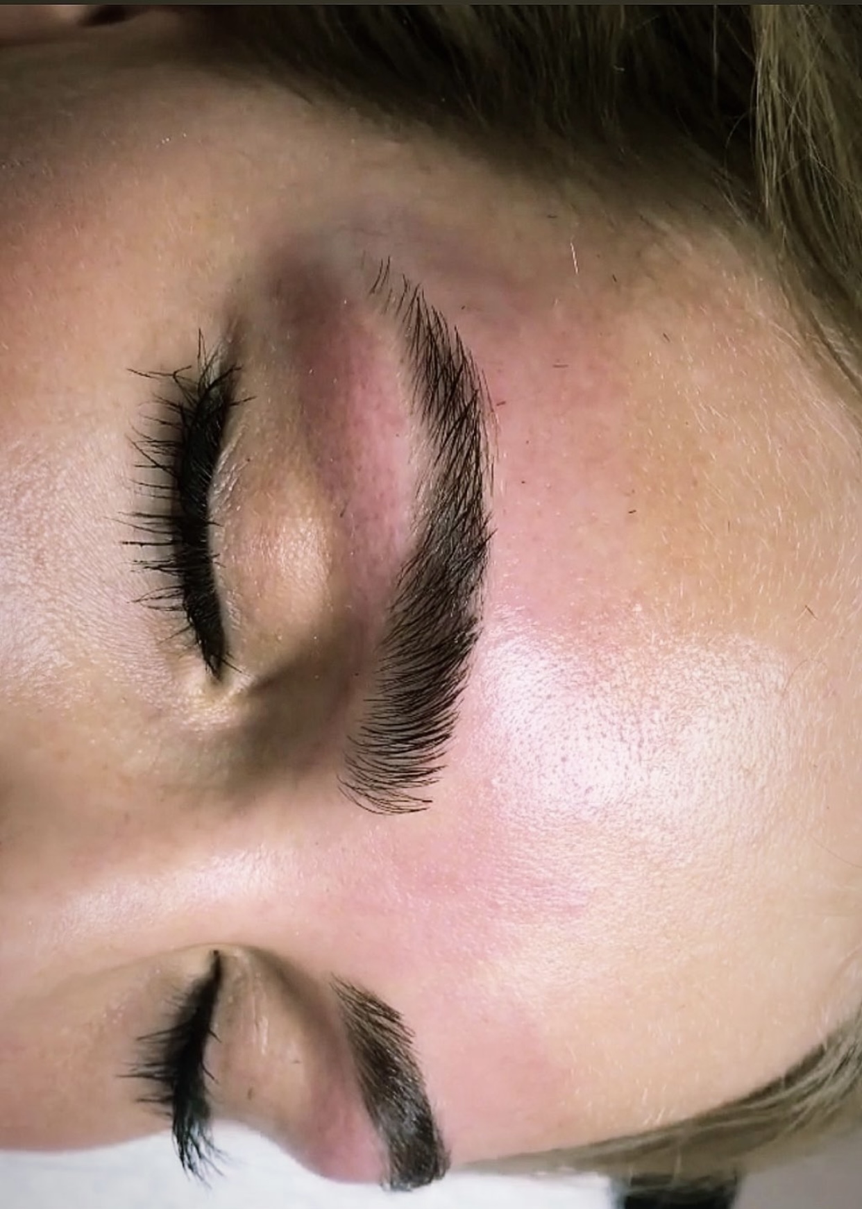 Kune efter korrektion af bryn