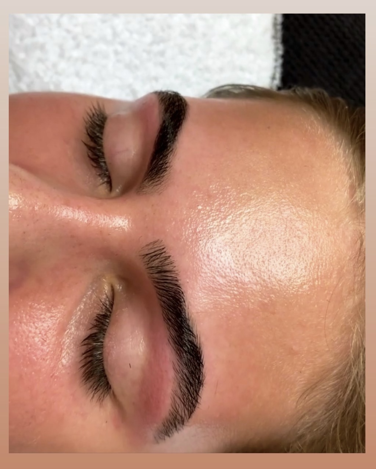 Kune efter korrektion af bryn