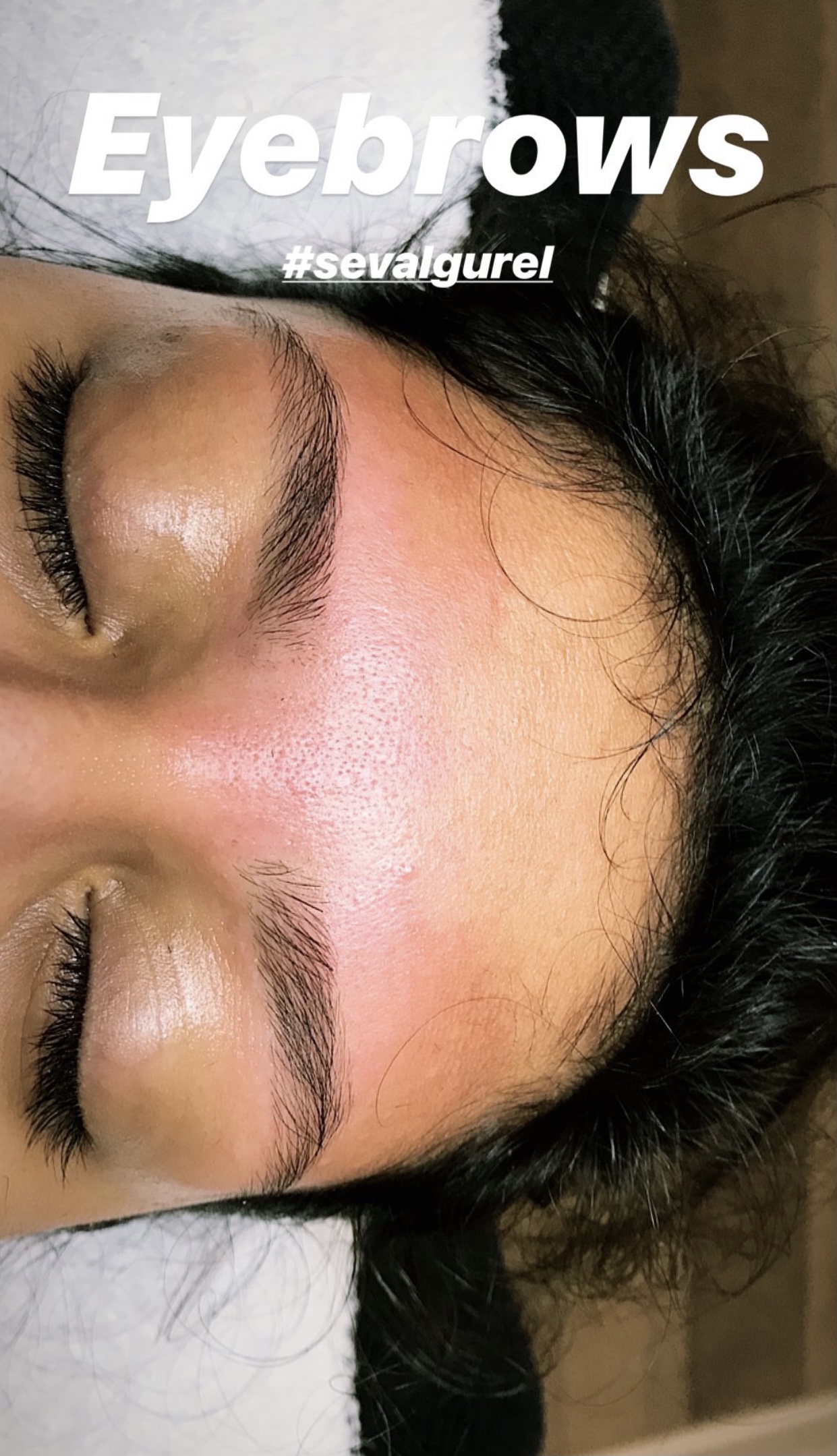 Kune efter korrektion af bryn